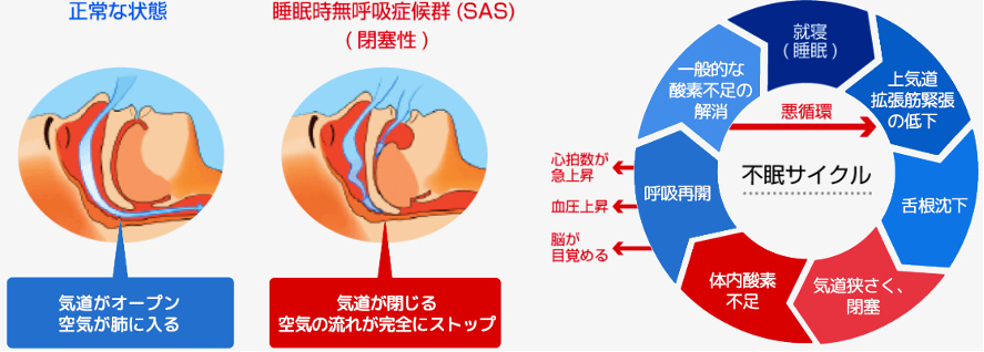 泉佐野あだちクリニック内科・小児科・アレルギー科 睡眠時無呼吸症候群の症状